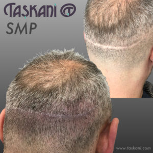 Scalp MicroPigmentatie Micro HaarPigmentatie Hair Tattoo Stoppeltattoo
